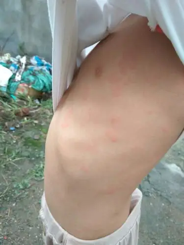 三岁男宝宝身上起大片红疹子