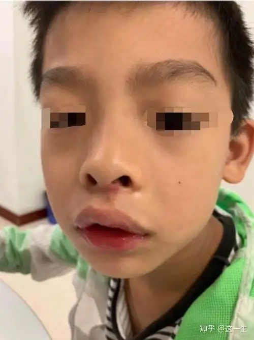 可怕的是长期的张口呼吸引起了腺样体面容,影响孩子的颜值.