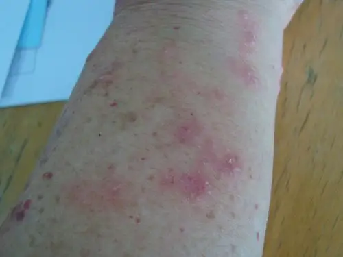 皮肤病体癣一例