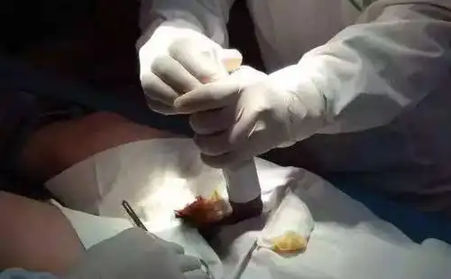 一次性切割成型止血,手术时间短,术后恢复快,患者术