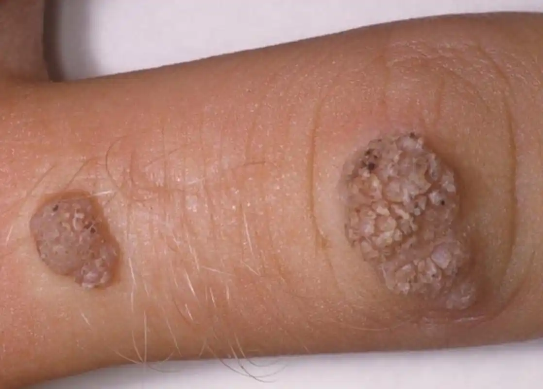 "菜花状的东西长在身上,一定就是尖锐湿疣吗?