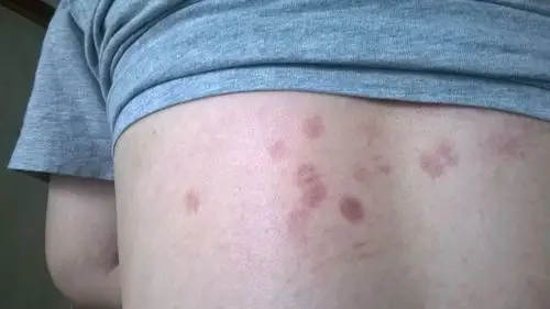 请问我这是什么皮肤病,背部长了红斑,不痛不痒,表面光滑