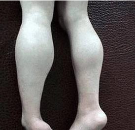 肌无力"与"肌营养不良"的区别|肌营养不良|肌肉|重症肌无力_新浪新闻