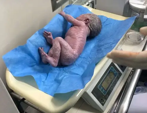 34孕周凌晨双胞胎儿子们一脚踹破羊水在新年之际早产出生了