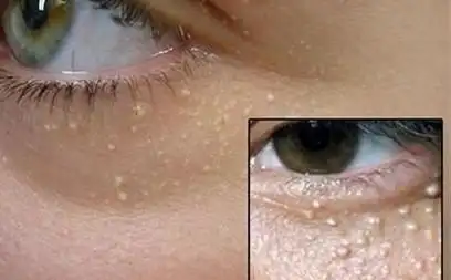 汗管瘤-让人头疼的"让人头疼的小疙瘩"