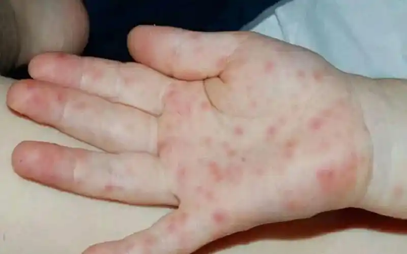 求儿童病毒疹的症状图片