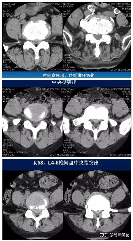 ube骨科权威教程5分钟掌握腰椎ct诊断技巧