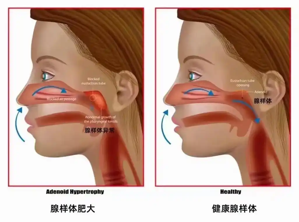 腺体样肥大,扁体桃,鼻炎是铁三 - 抖音
