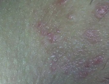 15岁女孩外阴有红色小痘痘很痒,是为啥?急