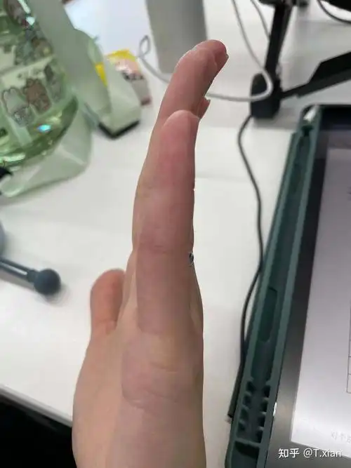 记录一下小拇指伸指肌腱断裂保守治疗