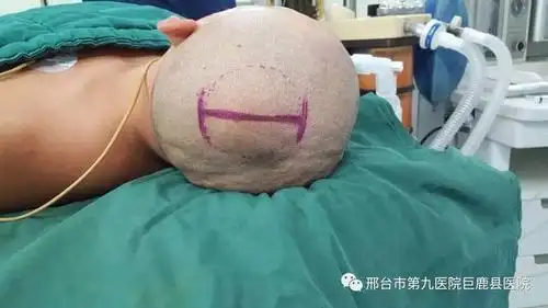 手术切口:头皮隆起处直切口. 图-04