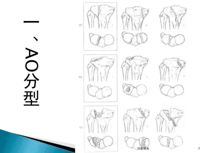 胫骨平台后侧柱骨折一类严选