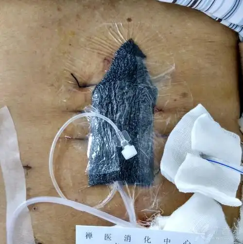 经验与教学之如何快速让感染的腹部切口,胃肠漏短期内愈合?