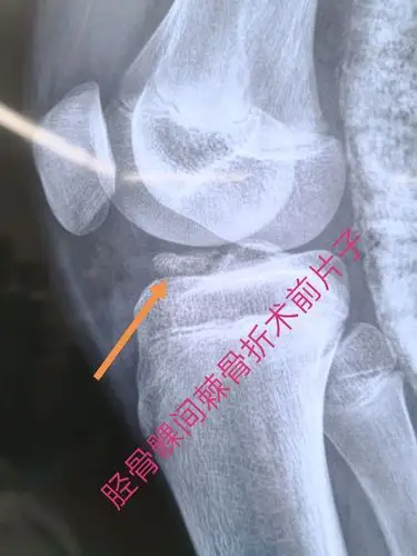 鹿邑真源医院骨二病区关节镜微创治疗髁间棘骨折