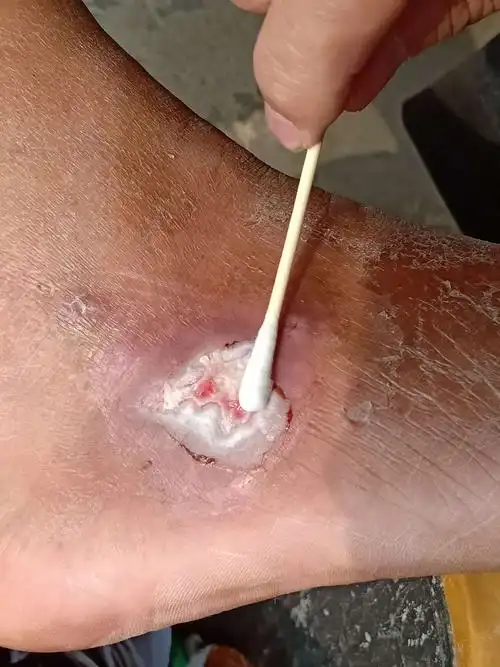 伤口肉芽组织鲜红色,颗粒状,深度已基本与皮面持平