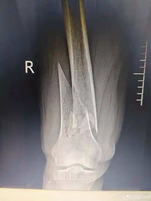 股骨远端骨折