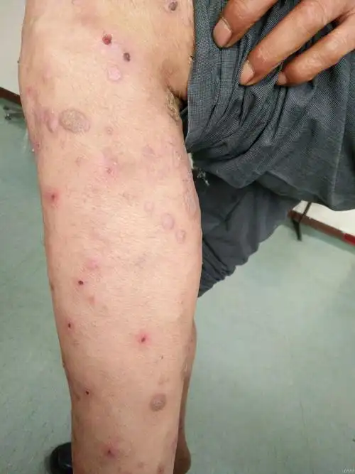 典型病例——结节性痒疹 - 皮肤及性传播疾病讨论版 - 爱爱医医学论坛