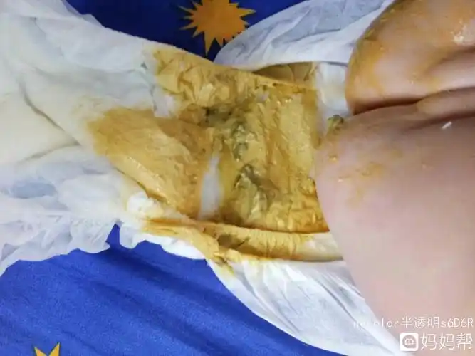 新生儿病情加重,甚至危及生命新生儿常见的便秘原因有1喂养因素的影响