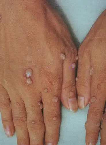 得了病毒疣不要急,看了这篇文章就清楚了_疣_疾病介绍_介绍 - 好大夫