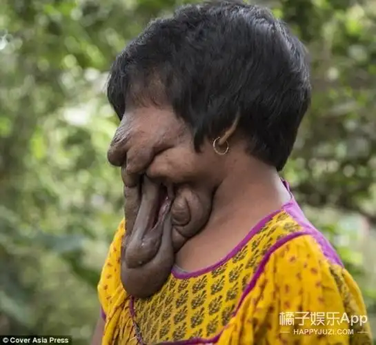印度21岁"无脸女"告诉你什么是大写的坚强