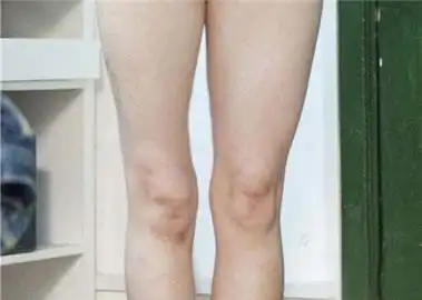 什么原因会导致肌肉萎缩-北京德胜门中医院中医内科(主诊神经肌肉系统