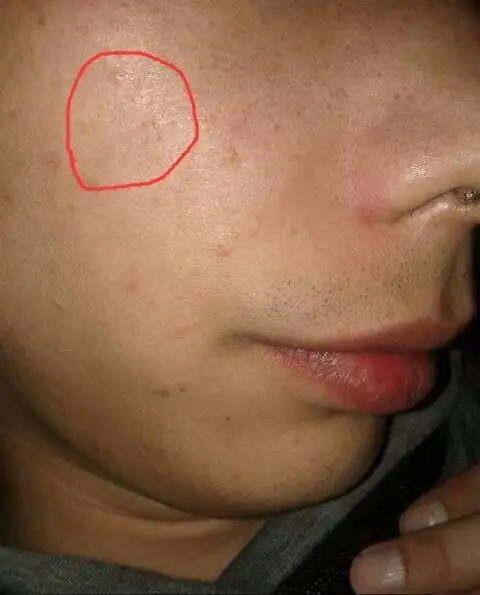 脸部螨虫肆虐,皮肤科专家教你一招,螨虫不见皮肤更加好