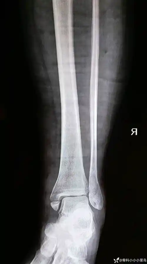 后踝撕脱骨块处理还是不处理