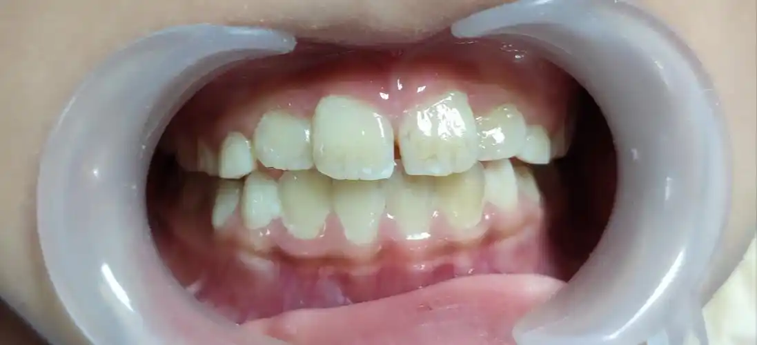 看看孩子的门牙是否正常?