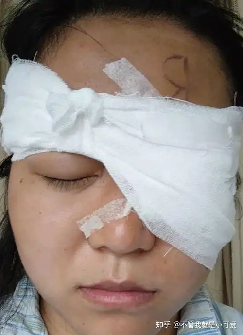 倒睫睑内倒翻造成结膜炎开刀手术