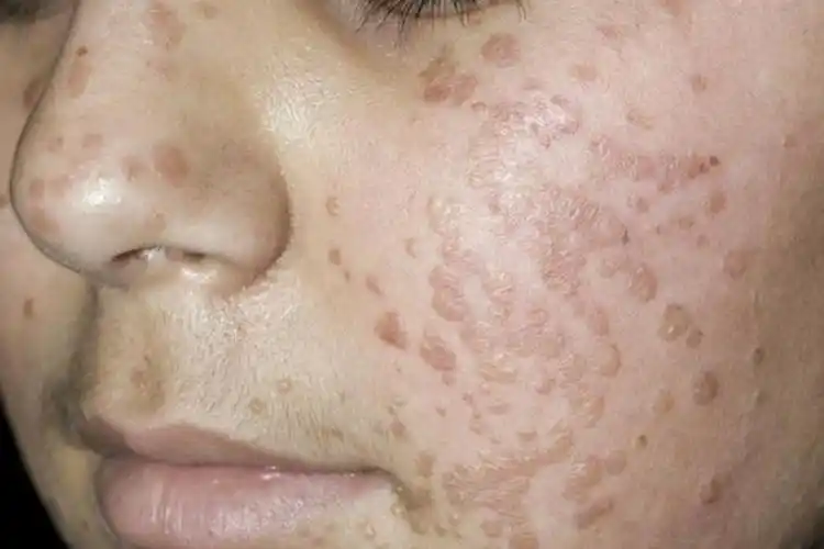 女性hpv疣体图片真实_有来医生