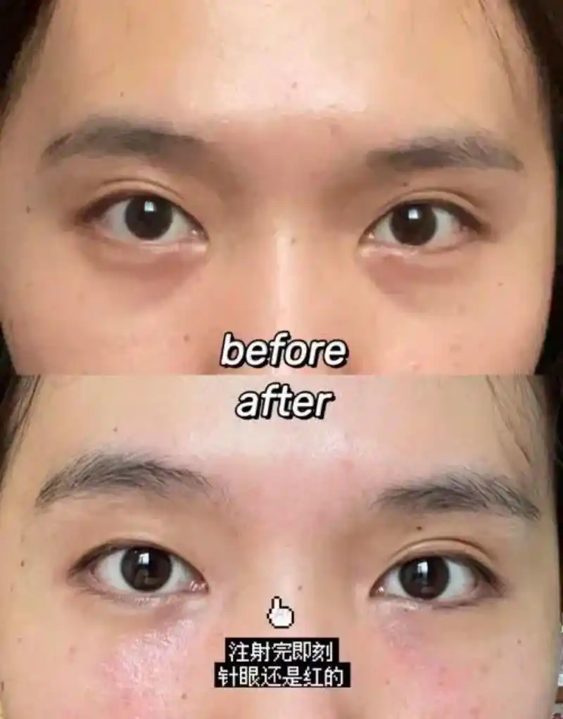 脸部泪沟凹陷怎么办?