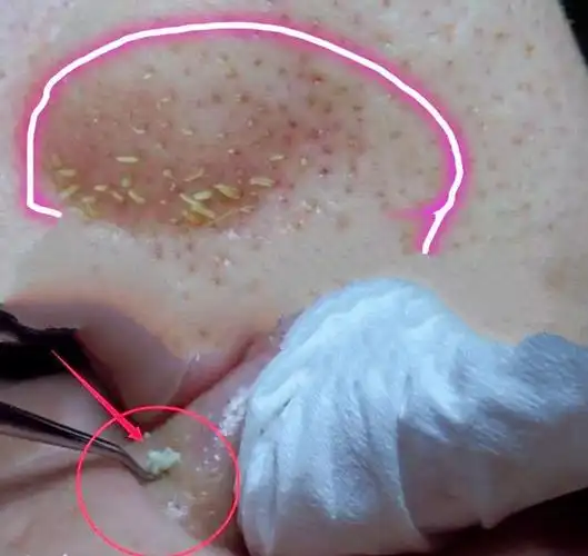 鼻子上挤出来的长条形白色物到底是什么东西