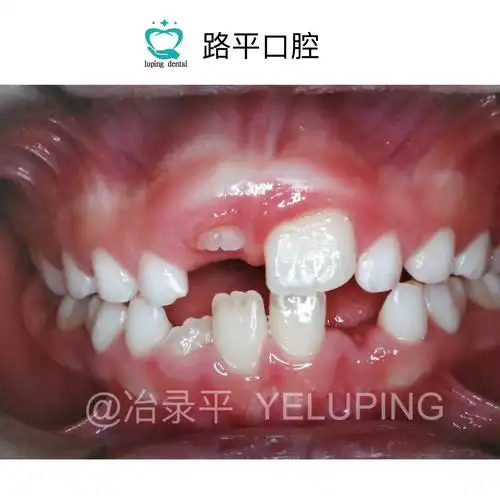 为什么孩子替换出来的门牙是锯齿状的