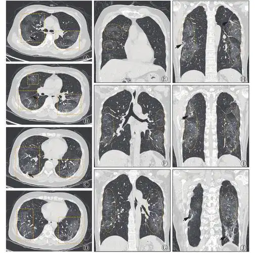 图 1          新型冠状病毒肺炎患者(女性,52岁)发病第8天的胸部ct肺