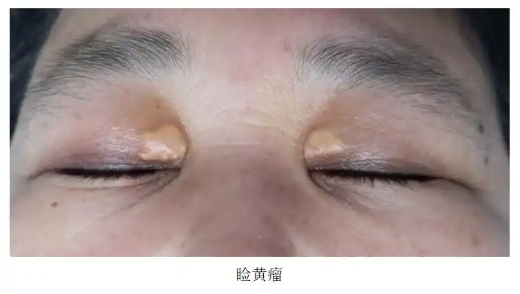 体表肿物科普——睑黄瘤篇_眼睑黄色瘤_症状表现_治疗方式_日常注意