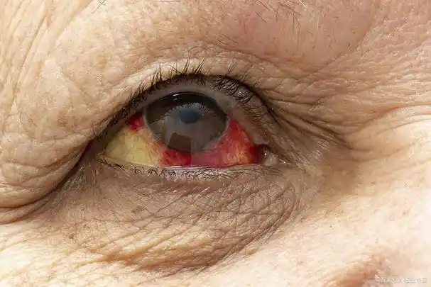 患上红眼病,可以用这7种方法让眼睛变得舒适些