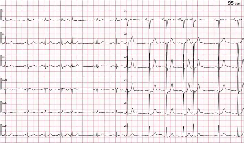 心电图图库丨交界性早搏系列