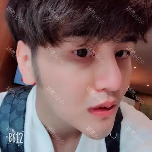 13 瑞港医疗 唇部手术》  今天拆线啦 只是在韩国拆线的 因为不想那么