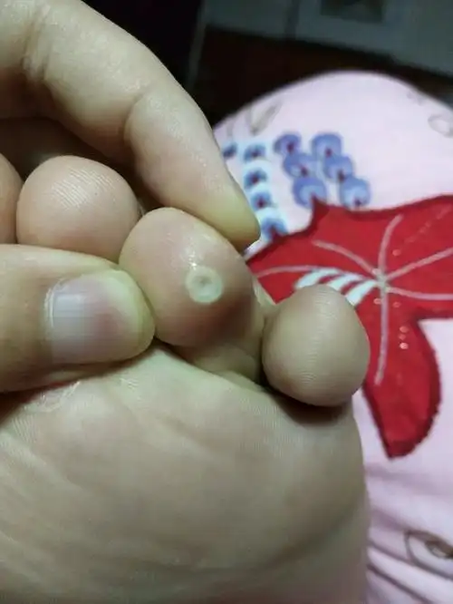 回复跖疣里面白色的是什么