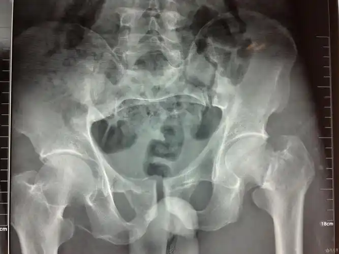 一例多发骨折治疗方式探讨