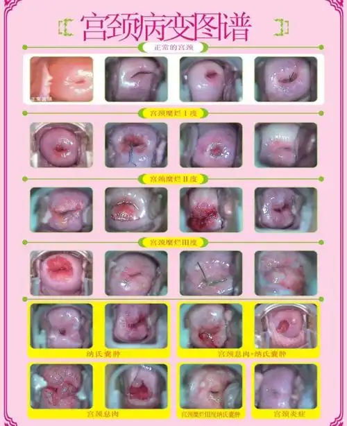宫颈息肉不治疗一般不会消失,需要手术除,但个别息肉在某些情况下,如