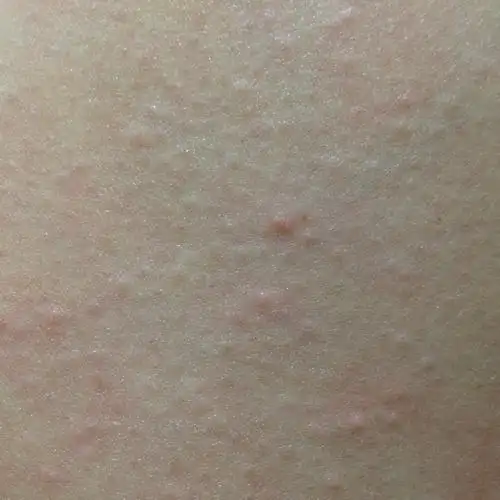 小红点有点痒,身上长了几个!不知道怎么回