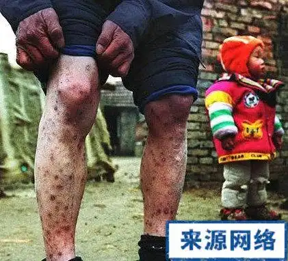 中国艾滋患者真实写照_艾滋病图谱_99健康网手机版