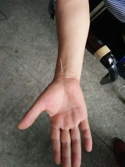 踝关节内侧疼痛针灸神效