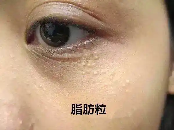 长了这么多年汗管瘤,你还以为是脂肪粒?
