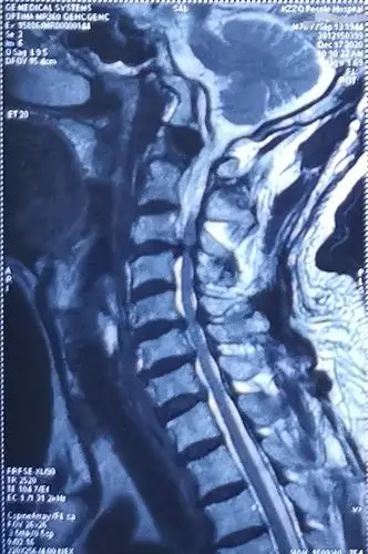 77岁颈椎间盘手术一例