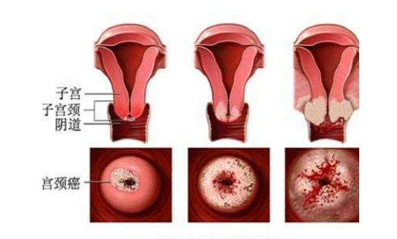 介入治疗在中晚期宫颈癌的临床应用 - 好大夫在线
