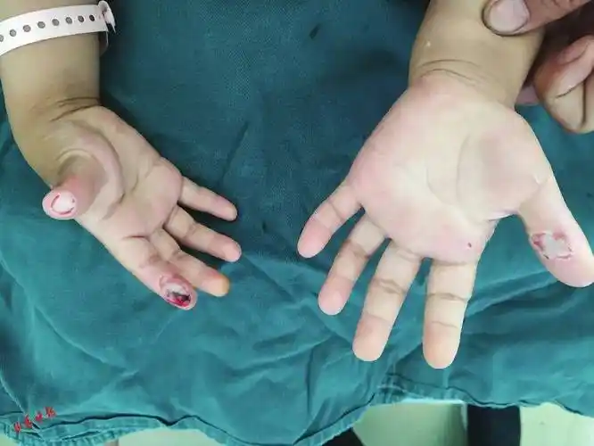 在太钢总医院(山西省烧伤救治中心)的急诊室里,前来就诊的患者中,因