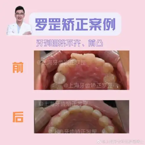 【纯矫正解决骨性前凸】95