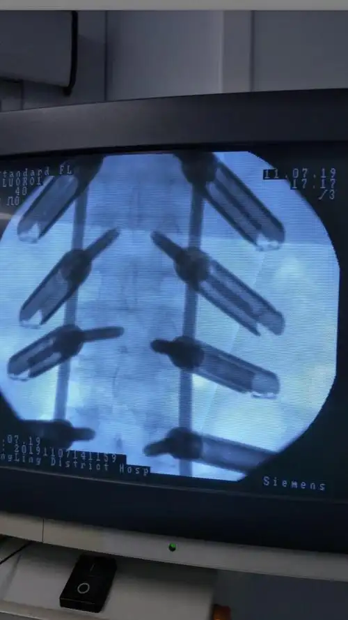 近日脊柱外科完成我院首例多发腰椎骨折经皮椎弓根螺钉复位内固定术!